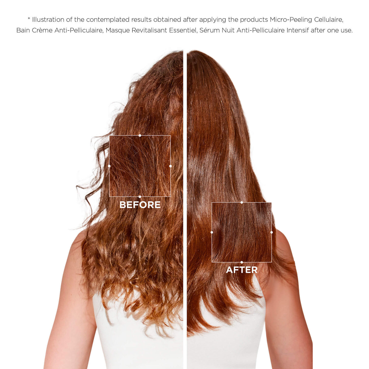 Dandruff with oily sale scalp